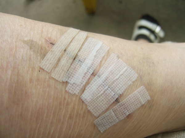 photo of laceration 
                     http://wlweather.net/LETTERS/2024BANN/0STITCH12AUG2024.JPG