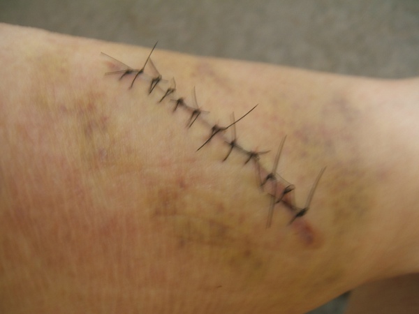 photo of laceration 
                     http://wlweather.net/LETTERS/2024BANN/12STTCH5AUG24.JPG
