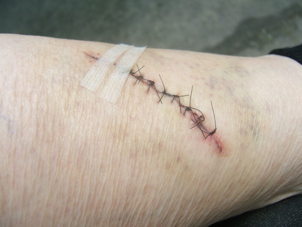 photo of laceration 
                     http://wlweather.net/LETTERS/2024BANN/12STTCH5AUG24.JPG